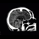 Meningioma of falx cerebri: CT - Computed tomography